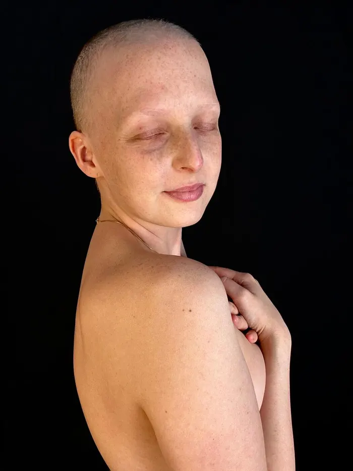 Porträt von Sarah Reimann während der Krebstherapie, mit rasiertem Kopf